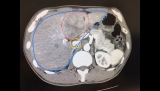 肝臓MR画像